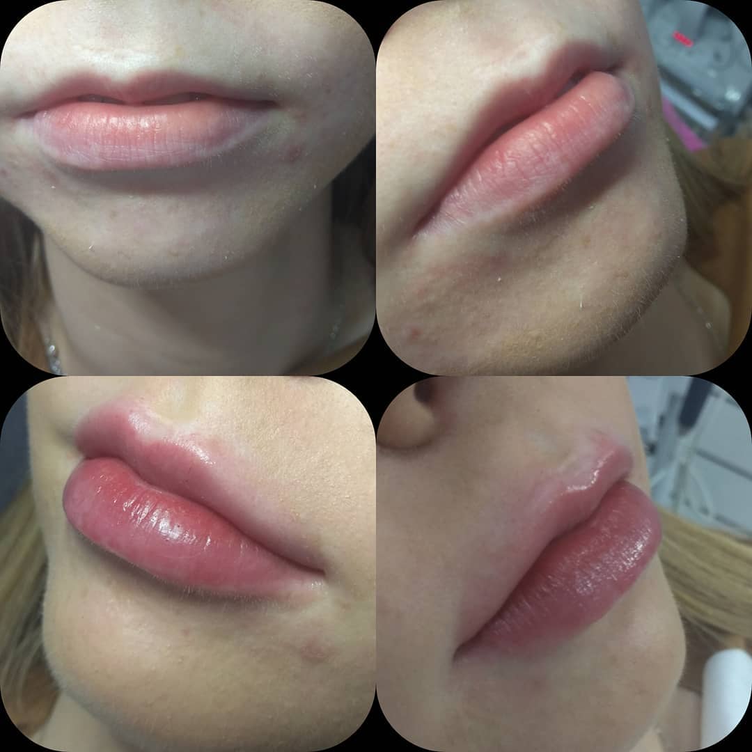Lips 1mlStylAgeSpecialLips