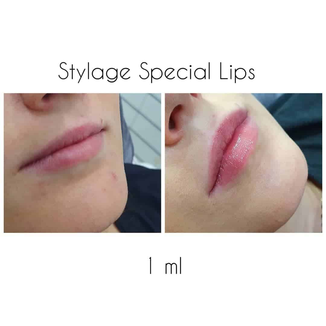 1 ml StyAge Special lips  Usta 2 tygodnie po zabiegu, całkowicie wygojone 

Wyk. Joanna